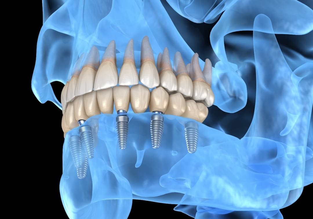 What are the Types of Dental Implants?