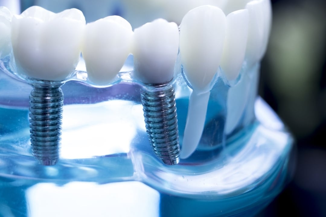 How To Choose the Right Dentist for Dental Implants?